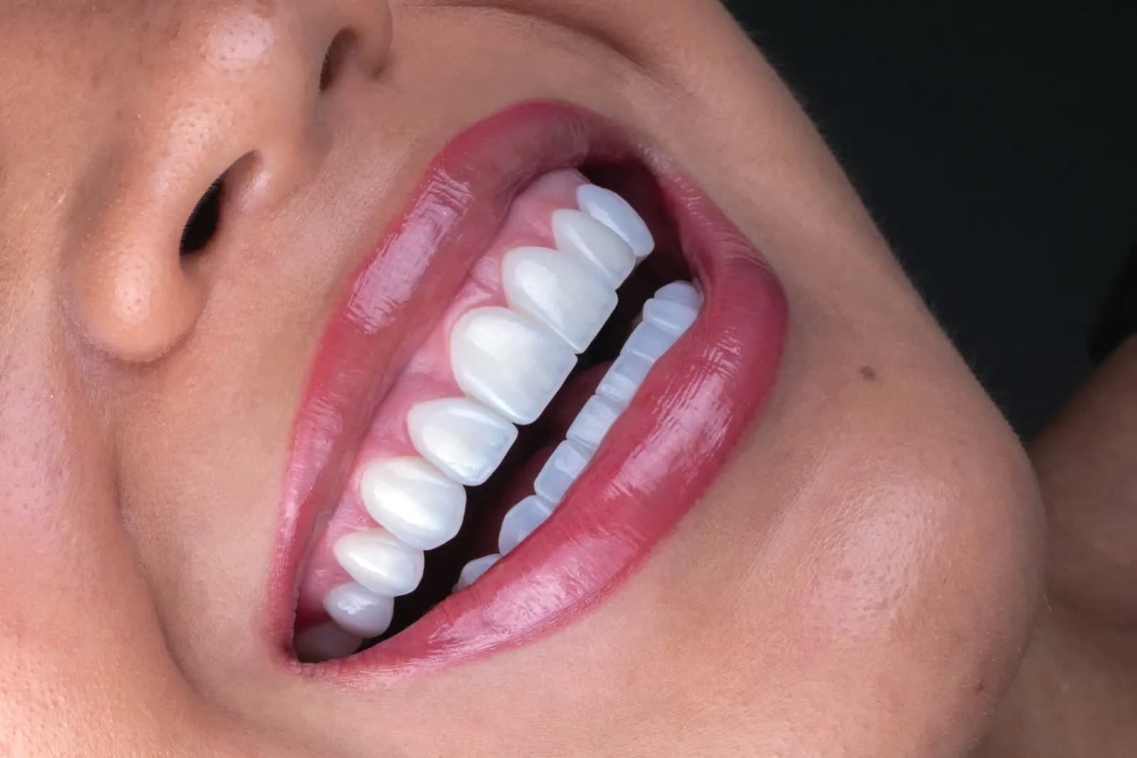 Whitening
