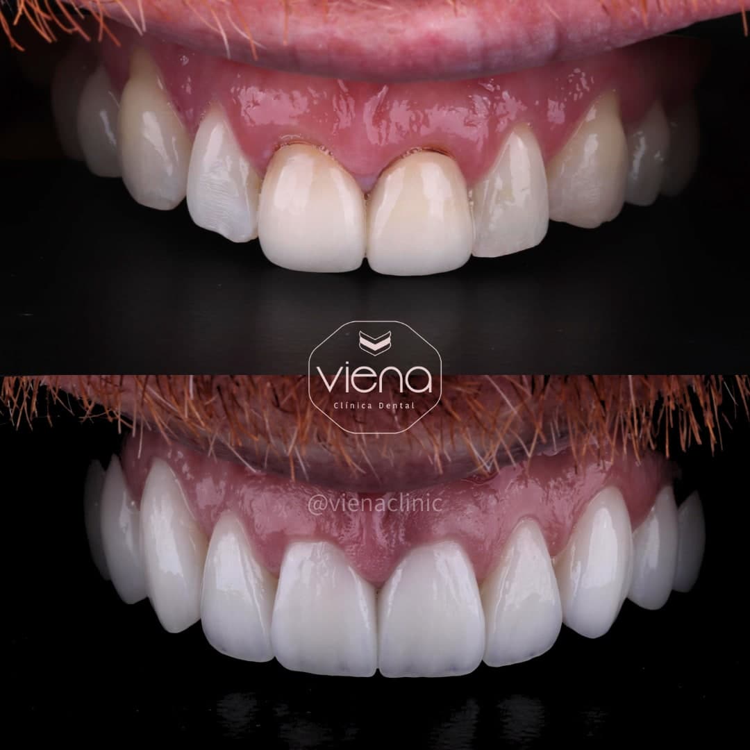 Diseño de Sonrisa en Cerámica
