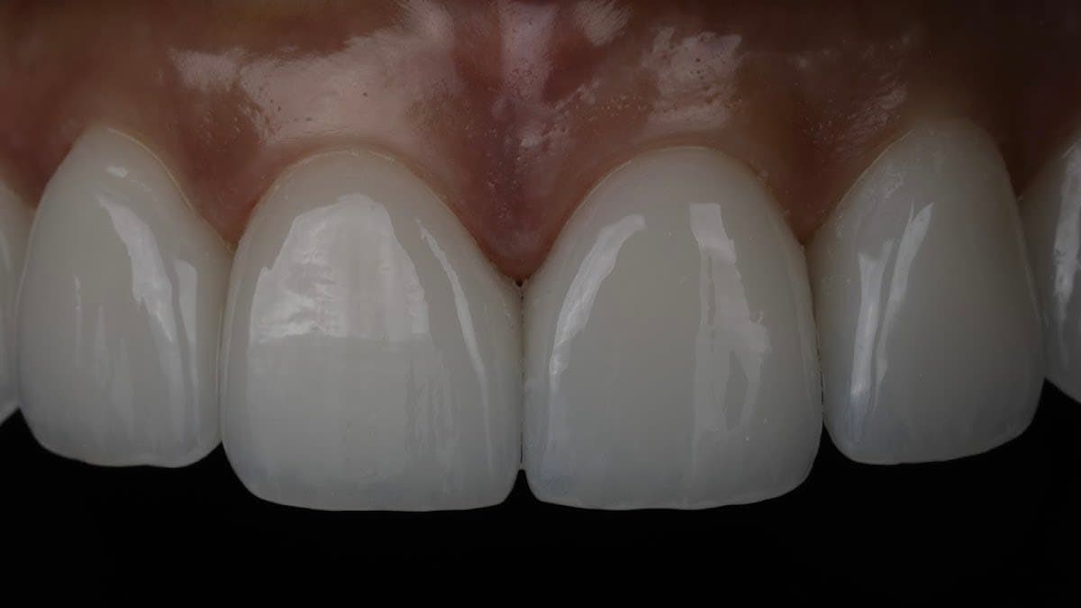 Pinhole Surgery