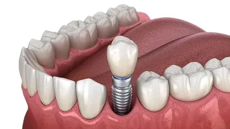 Impianti dentali a Roma I Clinicaltop